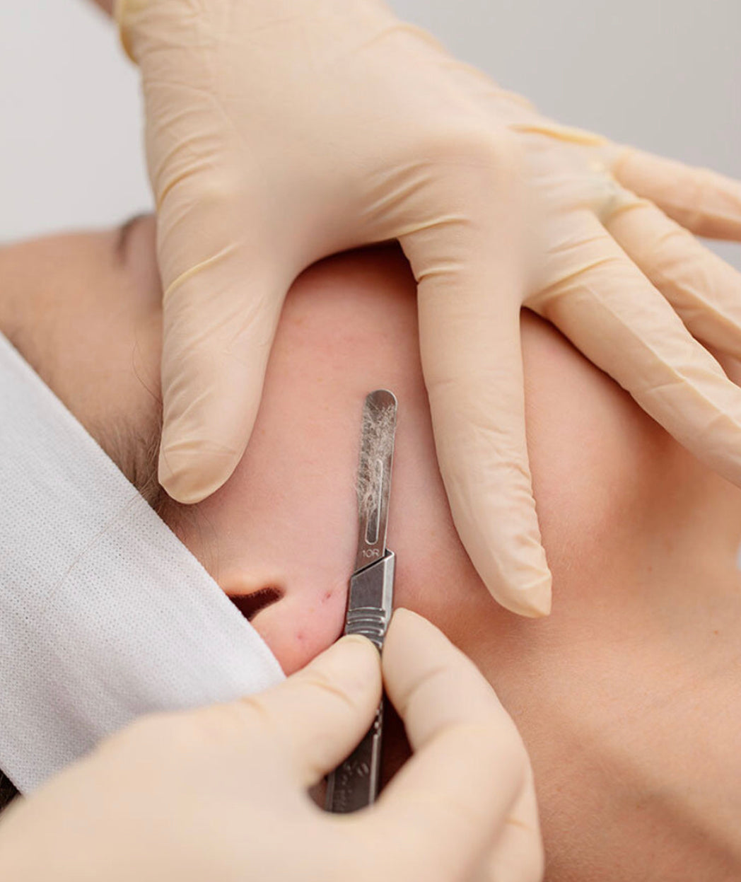 Dermaplaning